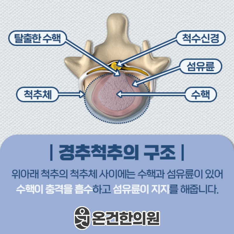 목디스크 증상에 맞춘 적절한 관리 시기와 방향