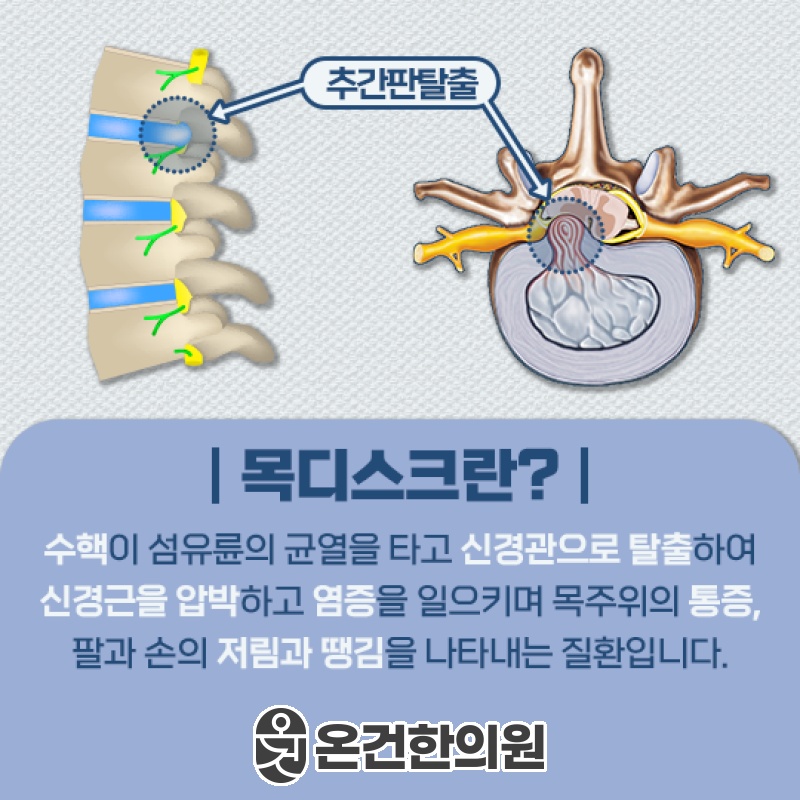 목디스크 증상에 맞춘 적절한 관리 시기와 방향