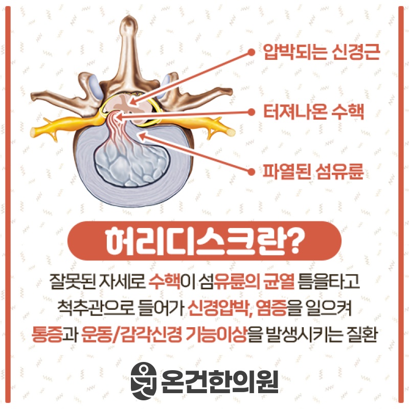 허리디스크 통증 완화를 위한 비수술적 관리 방법